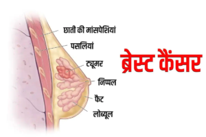 भारत में 2025 में बढ़ सकती है स्तन कैंसर की समस्या- ICMR